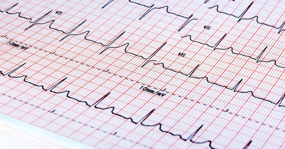 An electrocardiogram